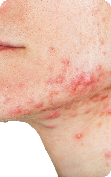 bibiotic derma helps