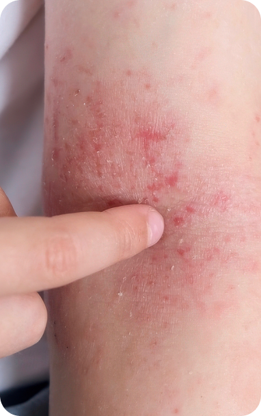 bibiotic derma helps